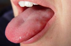 How to cure a papilloma on the tongue
