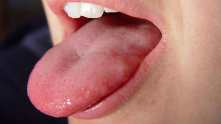 How to cure a papilloma on the tongue