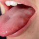 How to cure a papilloma on the tongue