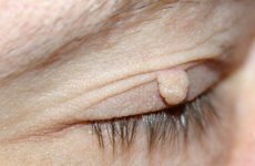 Is it worth worrying if papillomas appeared on the eyes, namely on the eyelid?