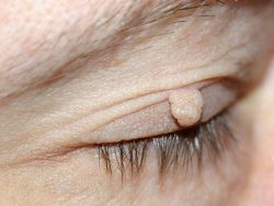Is it worth worrying if papillomas appeared on the eyes, namely on the eyelid?