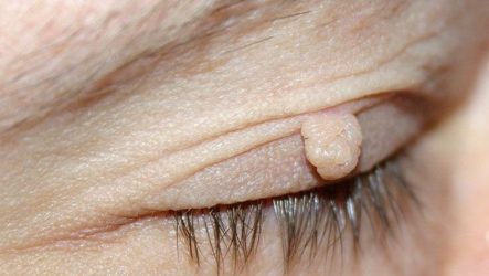 Is it worth worrying if papillomas appeared on the eyes, namely on the eyelid?