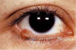 How to fight a papilloma on the eye?