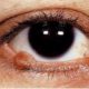 How to fight a papilloma on the eye?