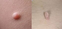 Papillomas and warts, how they look and what the differences are