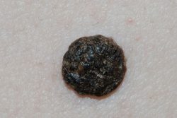 Why a papilloma turns black and where the danger lies