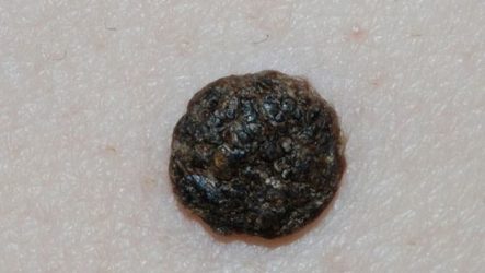 Why a papilloma turns black and where the danger lies