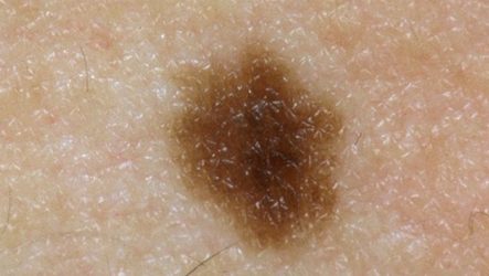 HPV or nevus and how to distinguish a papilloma from a mole?