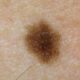 HPV or nevus and how to distinguish a papilloma from a mole?