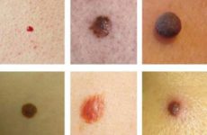 Classification of papilloma types and their treatment