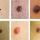Classification of papilloma types and their treatment