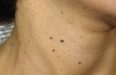 Causes of papillomas on the neck and how to treat them
