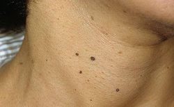Causes of papillomas on the neck and how to treat them