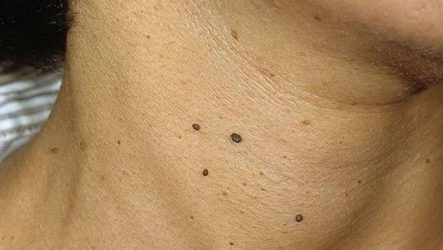 Causes of papillomas on the neck and how to treat them