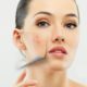 How to get rid of papilloma on the neck and face: features and recipes