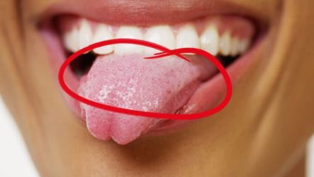 Condylomas in the mouth, on the tongue: photos and features of treatment