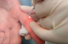 Laser papilloma removal procedure: its subtleties and patient reviews, approximate price