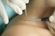 Papilloma removal with electrocoagulator: procedure, prices and reviews