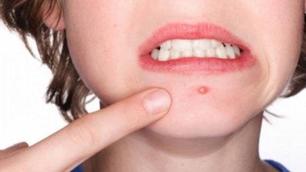 Guaranteed methods to get rid of warts on the face, how to remove quickly and permanently