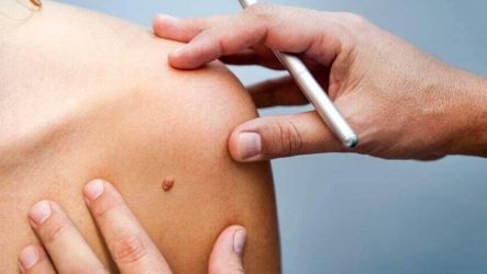Surgical removal of warts: advantages and disadvantages of this method