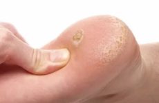 Causes and methods of treatment of heel warts at home