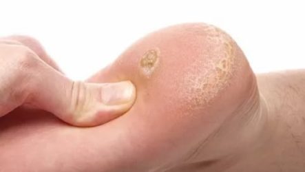 Causes and methods of treatment of heel warts at home