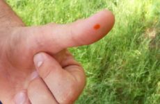 How to quickly and effectively get rid of (cure, remove, remove) a wart on your finger at home