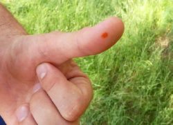 How to quickly and effectively get rid of (cure, remove, remove) a wart on your finger at home