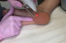 Modern methods of removing heel warts: how to remove it quickly?