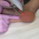 Modern methods of removing heel warts: how to remove it quickly?