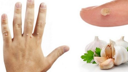 With what and how to cauterize, remove a wart at home: effective ways and possible complications