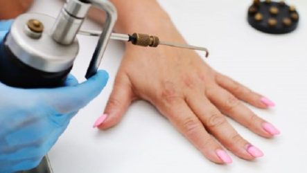 Quick and painless wart removal: cryosurgery