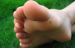 Medicinal and radical methods of treating chicken butt: with what and how to quickly cure a wart on the foot, heel, foot