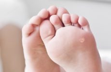 How to remove thorns on a child’s foot: an overview of treatment methods