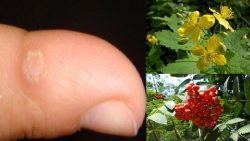 Folk remedies for removing warts: how to get rid of them quickly and effectively